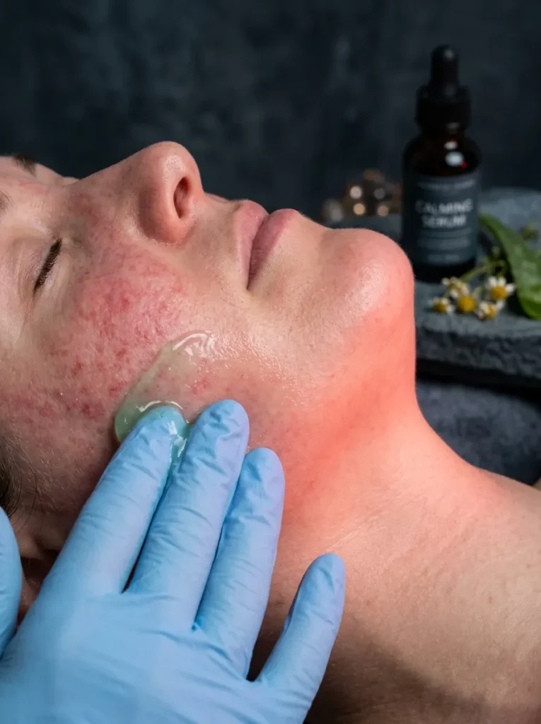 Soothes Sensitised Skin Alongside Scar Treatments